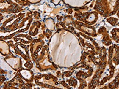 The image on the left is immunohistochemistry of paraffin-embedded Human thyroid cancer tissue using CSB-PA086865(TLR6 Antibody) at dilution 1/25, on the right is treated with fusion protein. (Original magnification: ×200)