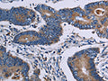 The image on the left is immunohistochemistry of paraffin-embedded Human colon cancer tissue using CSB-PA087882(ITK Antibody) at dilution 1/50, on the right is treated with fusion protein. (Original magnification: ×200)