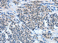 The image on the left is immunohistochemistry of paraffin-embedded Human esophagus cancer tissue using CSB-PA087889(EIF4EBP1 Antibody) at dilution 1/50, on the right is treated with fusion protein. (Original magnification: ×200)