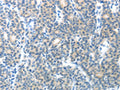 The image on the left is immunohistochemistry of paraffin-embedded Human thyroid cancer tissue using CSB-PA088258(CEACAM1 Antibody) at dilution 1/25, on the right is treated with fusion protein. (Original magnification: ×200)