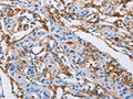 The image on the left is immunohistochemistry of paraffin-embedded Human lung cancer tissue using CSB-PA088669(LAIR1 Antibody) at dilution 1/30, on the right is treated with fusion protein. (Original magnification: ×200)