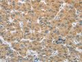 The image on the left is immunohistochemistry of paraffin-embedded Human liver cancer tissue using CSB-PA088788(CYP2C9 Antibody) at dilution 1/35, on the right is treated with fusion protein. (Original magnification: ×200)