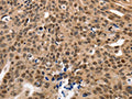 The image on the left is immunohistochemistry of paraffin-embedded Human ovarian cancer tissue using CSB-PA089095(NAIF1 Antibody) at dilution 1/60, on the right is treated with fusion protein. (Original magnification: ×200)