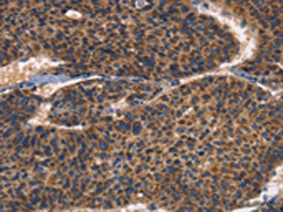 The image on the left is immunohistochemistry of paraffin-embedded Human liver cancer tissue using CSB-PA089157(ITGB3 Antibody) at dilution 1/30, on the right is treated with fusion protein. (Original magnification: ×200)