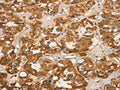 The image on the left is immunohistochemistry of paraffin-embedded Human thyroid cancer tissue using CSB-PA089183(RBBP8 Antibody) at dilution 1/65, on the right is treated with fusion protein. (Original magnification: ×200)