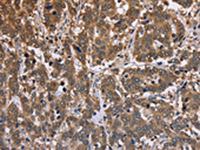 The image on the left is immunohistochemistry of paraffin-embedded Human liver cancer tissue using CSB-PA089265(FBP2 Antibody) at dilution 1/40, on the right is treated with fusion protein. (Original magnification: ×200)