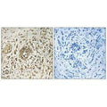 Immunohistochemistry analysis of paraffin-embedded human breast carcinoma tissue, using CIB2 antibody.
