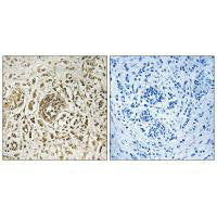 Immunohistochemistry analysis of paraffin-embedded human breast carcinoma tissue, using CIB2 antibody.