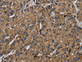 The image on the left is immunohistochemistry of paraffin-embedded Human liver cancer tissue using CSB-PA089578(NDUFS6 Antibody) at dilution 1/50, on the right is treated with fusion protein. (Original magnification: ×200)