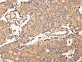 The image on the left is immunohistochemistry of paraffin-embedded Human prostate cancer tissue using CSB-PA090286(ALDH3A2 Antibody) at dilution 1/20, on the right is treated with fusion protein. (Original magnification: ×200)
