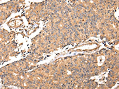 The image on the left is immunohistochemistry of paraffin-embedded Human prostate cancer tissue using CSB-PA090286(ALDH3A2 Antibody) at dilution 1/20, on the right is treated with fusion protein. (Original magnification: ×200)
