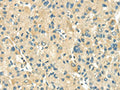 The image on the left is immunohistochemistry of paraffin-embedded Human liver cancer tissue using CSB-PA090362(TXN2 Antibody) at dilution 1/30, on the right is treated with fusion protein. (Original magnification: ×200)