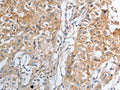 The image on the left is immunohistochemistry of paraffin-embedded Human lung cancer tissue using CSB-PA090386(HAVCR1 Antibody) at dilution 1/25, on the right is treated with synthetic peptide. (Original magnification: ×200)