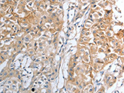 The image on the left is immunohistochemistry of paraffin-embedded Human lung cancer tissue using CSB-PA090386(HAVCR1 Antibody) at dilution 1/25, on the right is treated with synthetic peptide. (Original magnification: ×200)