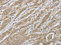 The image on the left is immunohistochemistry of paraffin-embedded Human gastic cancer tissue using CSB-PA090786(EEF2 Antibody) at dilution 1/20, on the right is treated with fusion protein. (Original magnification: ×200)