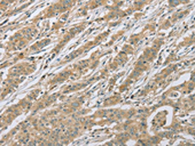 The image on the left is immunohistochemistry of paraffin-embedded Human gastic cancer tissue using CSB-PA090786(EEF2 Antibody) at dilution 1/20, on the right is treated with fusion protein. (Original magnification: ×200)