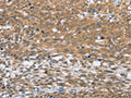 The image on the left is immunohistochemistry of paraffin-embedded Human cervical cancer tissue using CSB-PA091025(MLH1 Antibody) at dilution 1/60, on the right is treated with fusion protein. (Original magnification: ×200)