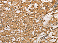 The image on the left is immunohistochemistry of paraffin-embedded Human thyroid cancer tissue using CSB-PA091163(ARHGEF5 Antibody) at dilution 1/50, on the right is treated with fusion protein. (Original magnification: ×200)