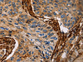 The image on the left is immunohistochemistry of paraffin-embedded Human lung cancer tissue using CSB-PA091165(CALD1 Antibody) at dilution 1/35, on the right is treated with fusion protein. (Original magnification: ×200)
