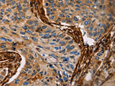 The image on the left is immunohistochemistry of paraffin-embedded Human lung cancer tissue using CSB-PA091165(CALD1 Antibody) at dilution 1/35, on the right is treated with fusion protein. (Original magnification: ×200)