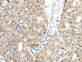 The image on the left is immunohistochemistry of paraffin-embedded Human ovarian cancer tissue using CSB-PA091701(MAP3K14 Antibody) at dilution 1/30, on the right is treated with fusion protein. (Original magnification: ×200)