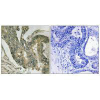 Immunohistochemistry analysis of paraffin-embedded human colon carcinoma tissue using ALDOC antibody.
