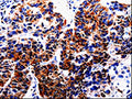 The image on the left is immunohistochemistry of paraffin-embedded Human lung cancer tissue using CSB-PA092212(HTR2B Antibody) at dilution 1/20, on the right is treated with fusion protein. (Original magnification: ×200)
