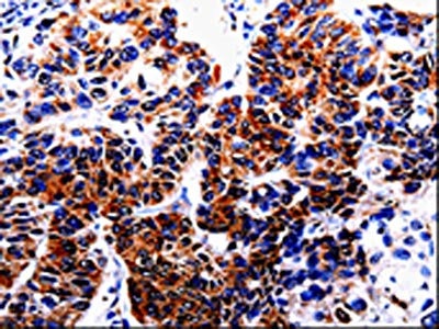 The image on the left is immunohistochemistry of paraffin-embedded Human lung cancer tissue using CSB-PA092212(HTR2B Antibody) at dilution 1/20, on the right is treated with fusion protein. (Original magnification: ×200)
