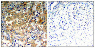 Immunohistochemical analysis of paraffin-embedded human lung carcinoma tissue using PKC&zeta; (Phospho-Thr410) antibody.