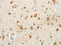 The image on the left is immunohistochemistry of paraffin-embedded Human brain tissue using CSB-PA092850(RPAP3 Antibody) at dilution 1/20, on the right is treated with fusion protein. (Original magnification: ×200)