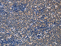 The image on the left is immunohistochemistry of paraffin-embedded Human lymphoma tissue using CSB-PA092883(ALG12 Antibody) at dilution 1/20, on the right is treated with fusion protein. (Original magnification: ×200)