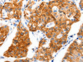 The image on the left is immunohistochemistry of paraffin-embedded Human lung cancer tissue using CSB-PA092898(SLC2A4 Antibody) at dilution 1/70, on the right is treated with synthetic peptide. (Original magnification: ×200)