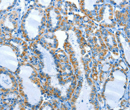 Immunohistochemical analysis of paraffin-embedded Human thyroid cancer tissue using at dilution 1/25.