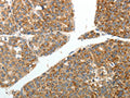 The image on the left is immunohistochemistry of paraffin-embedded Human liver cancer tissue using CSB-PA093393(RETNLB Antibody) at dilution 1/20, on the right is treated with fusion protein. (Original magnification: ×200)