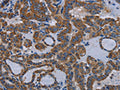 The image on the left is immunohistochemistry of paraffin-embedded Human thyroid cancer tissue using CSB-PA093669(EDNRB Antibody) at dilution 1/30, on the right is treated with synthetic peptide. (Original magnification: ×200)