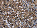 The image on the left is immunohistochemistry of paraffin-embedded Human liver cancer tissue using CSB-PA093769(SETD7 Antibody) at dilution 1/20, on the right is treated with fusion protein. (Original magnification: ×200)