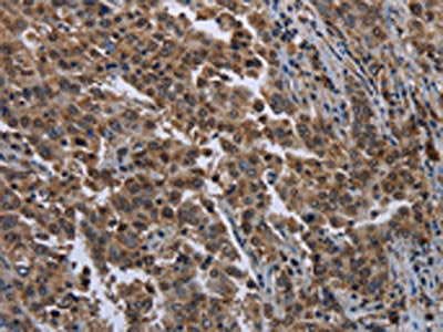 The image on the left is immunohistochemistry of paraffin-embedded Human liver cancer tissue using CSB-PA093769(SETD7 Antibody) at dilution 1/20, on the right is treated with fusion protein. (Original magnification: ×200)