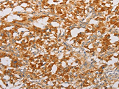 The image on the left is immunohistochemistry of paraffin-embedded Human thyroid cancer tissue using CSB-PA093779(BNIP3 Antibody) at dilution 1/20, on the right is treated with fusion protein. (Original magnification: ×200)