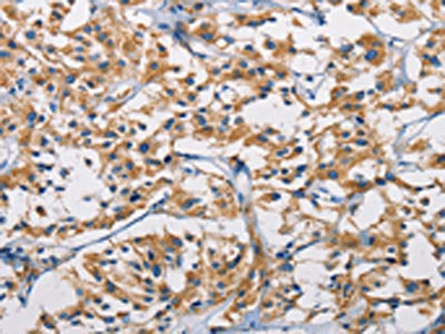 The image on the left is immunohistochemistry of paraffin-embedded Human thyroid cancer tissue using CSB-PA093794(HK1 Antibody) at dilution 1/50, on the right is treated with fusion protein. (Original magnification: ×200)