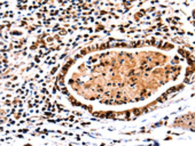 The image on the left is immunohistochemistry of paraffin-embedded Human stomach cancer tissue using CSB-PA094007(DNMT3A Antibody) at dilution 1/65, on the right is treated with fusion protein. (Original magnification: ×200)