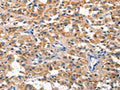 The image on the left is immunohistochemistry of paraffin-embedded Human thyroid cancer tissue using CSB-PA094054(DUSP2 Antibody) at dilution 1/30, on the right is treated with synthetic peptide. (Original magnification: ×200)