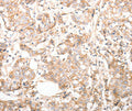 Immunohistochemical analysis of paraffin-embedded Human breast cancer tissue using at dilution 1/30.