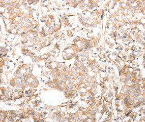 Immunohistochemical analysis of paraffin-embedded Human breast cancer tissue using at dilution 1/30.