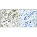 Immunohistochemistry analysis of paraffin-embedded human breast carcinoma tissue using TCEAL3/5/6 antibody.