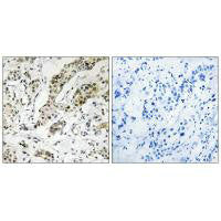 Immunohistochemistry analysis of paraffin-embedded human breast carcinoma tissue using TCEAL3/5/6 antibody.