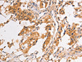 The image on the left is immunohistochemistry of paraffin-embedded Human thyroid cancer tissue using CSB-PA094535(PIP5K1A Antibody) at dilution 1/30, on the right is treated with fusion protein. (Original magnification: ×200)