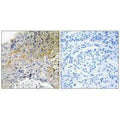 Immunohistochemical analysis of paraffin-embedded human breast carcinoma tissue using p130 Cas (Ab-410) antibody.