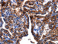 The image on the left is immunohistochemistry of paraffin-embedded Human thyroid cancer tissue using CSB-PA095417(GIP Antibody) at dilution 1/15, on the right is treated with fusion protein. (Original magnification: ×200)