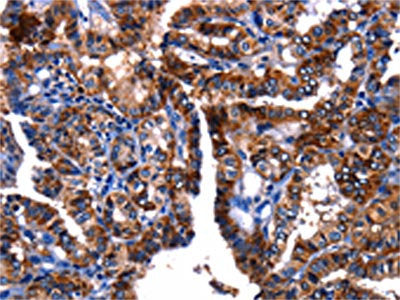 The image on the left is immunohistochemistry of paraffin-embedded Human thyroid cancer tissue using CSB-PA095417(GIP Antibody) at dilution 1/15, on the right is treated with fusion protein. (Original magnification: ×200)