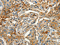 The image on the left is immunohistochemistry of paraffin-embedded Human lung cancer tissue using CSB-PA095703(CALCA Antibody) at dilution 1/60, on the right is treated with synthetic peptide. (Original magnification: ×200)
